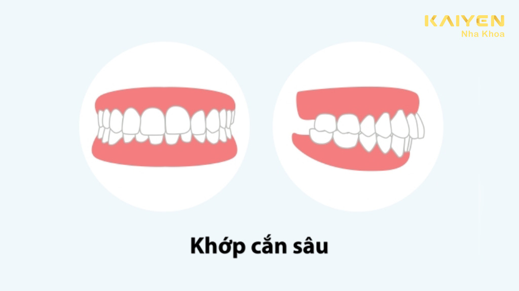 Khớp cắn sâu