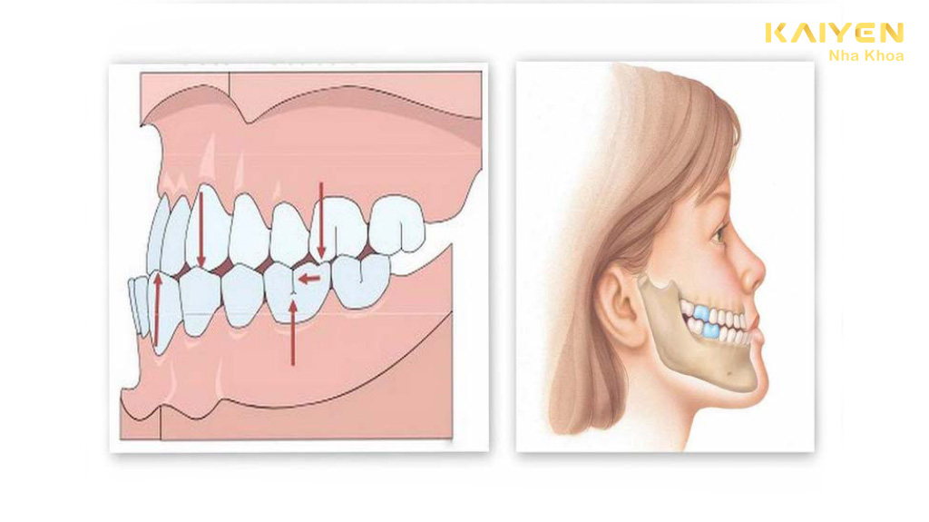 Sai khớp cắn loại 3