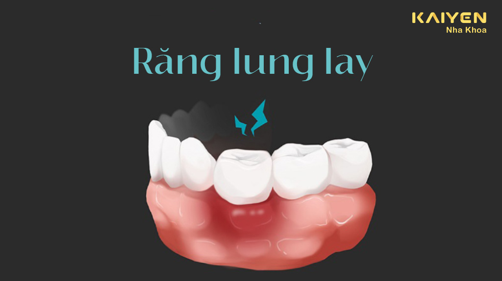 Răng lung lay