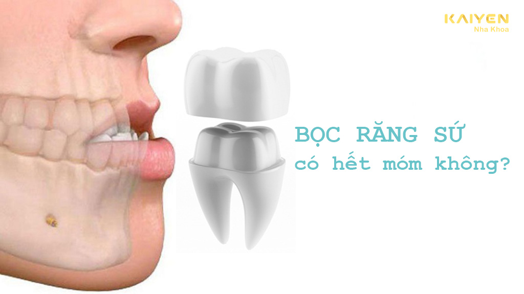 Bọc răng sứ có hết móm không?