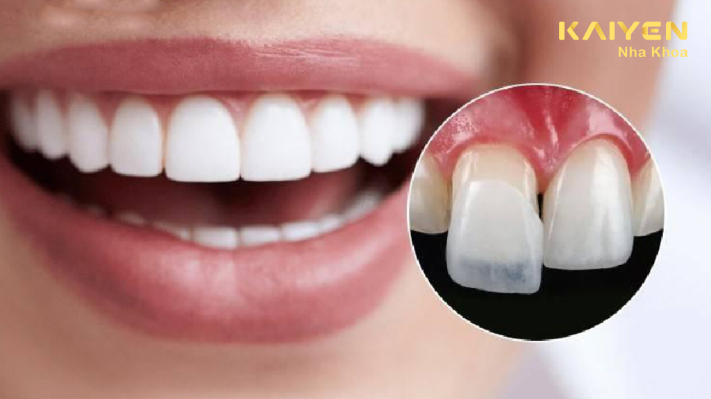 dán sứ veneer 2 răng cửa giúp khắc phục khuyết điểm răng