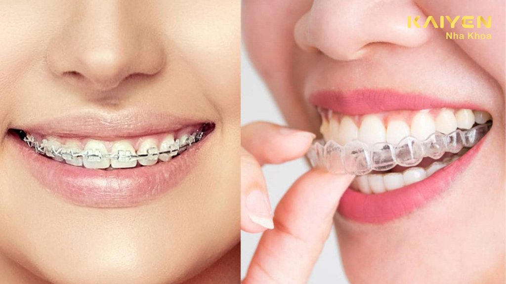 Bao nhiêu tuổi thì không được niềng răng