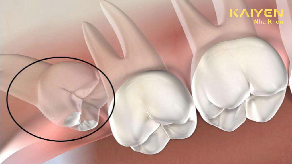 răng khôn mọc lệch hàm trên