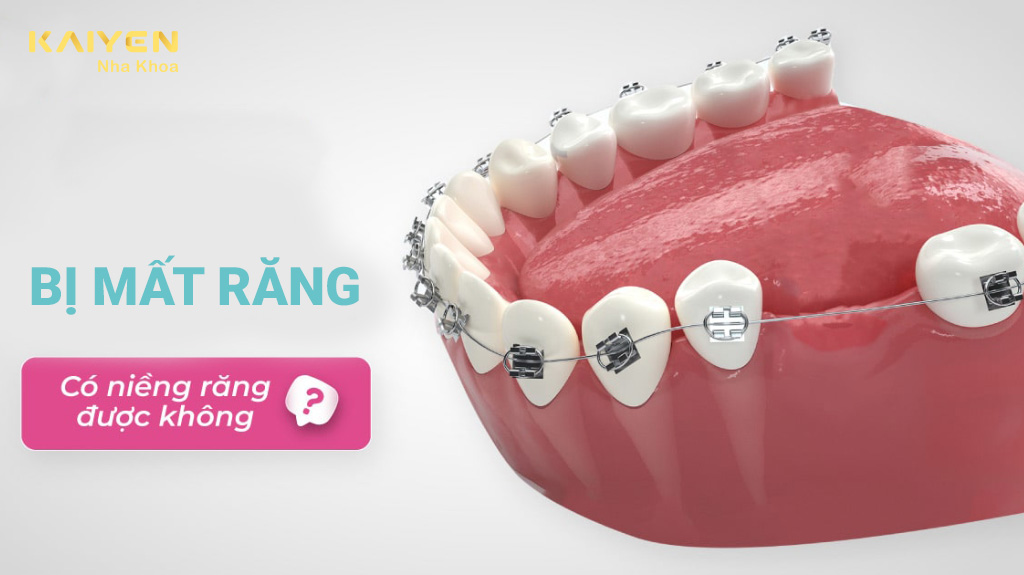 Mất răng có niềng răng được không