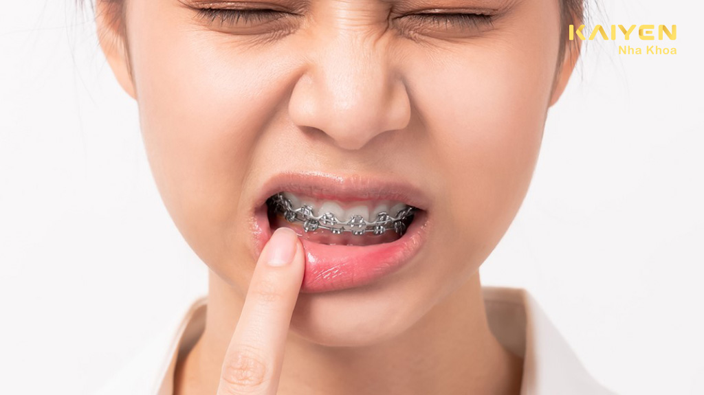 Tác hại của niềng răng sai cách