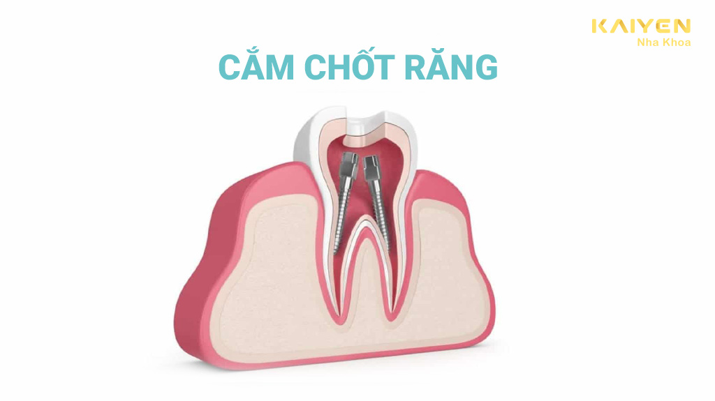 cắm chốt răng