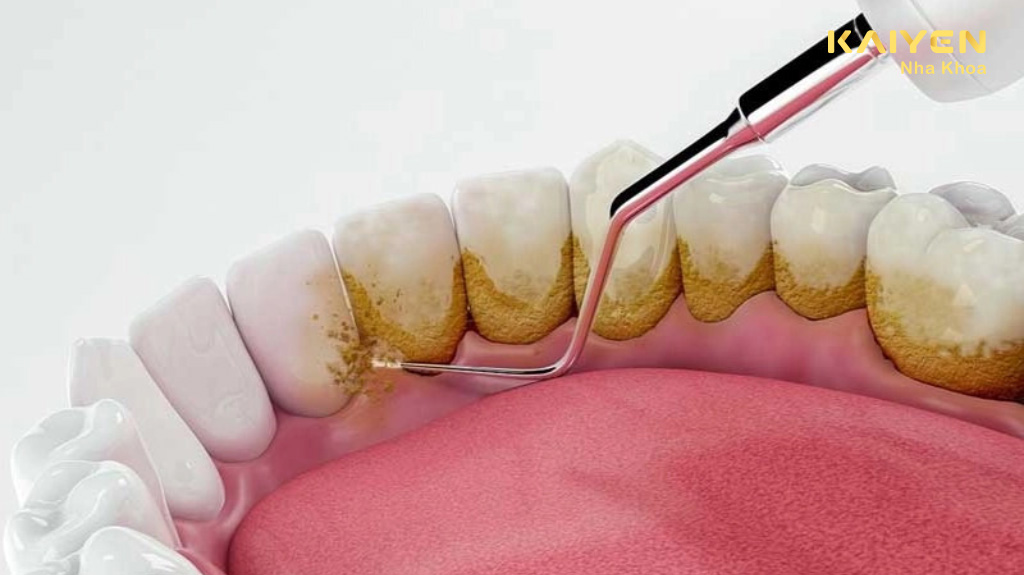 Cạo vôi răng có hết hôi miệng không