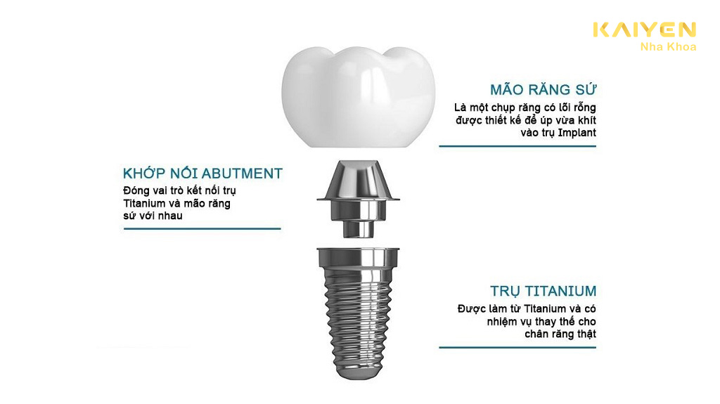 Cấu tạo răng implant