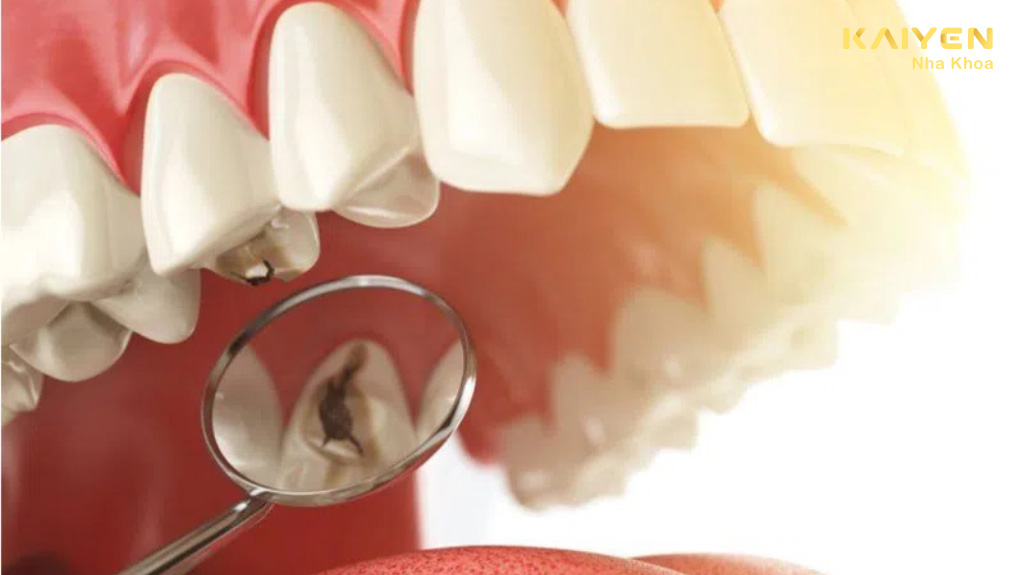 Răng sâu có niềng được không