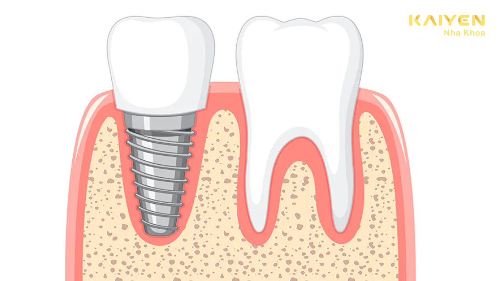 Thời điểm trồng răng implant phù hợp