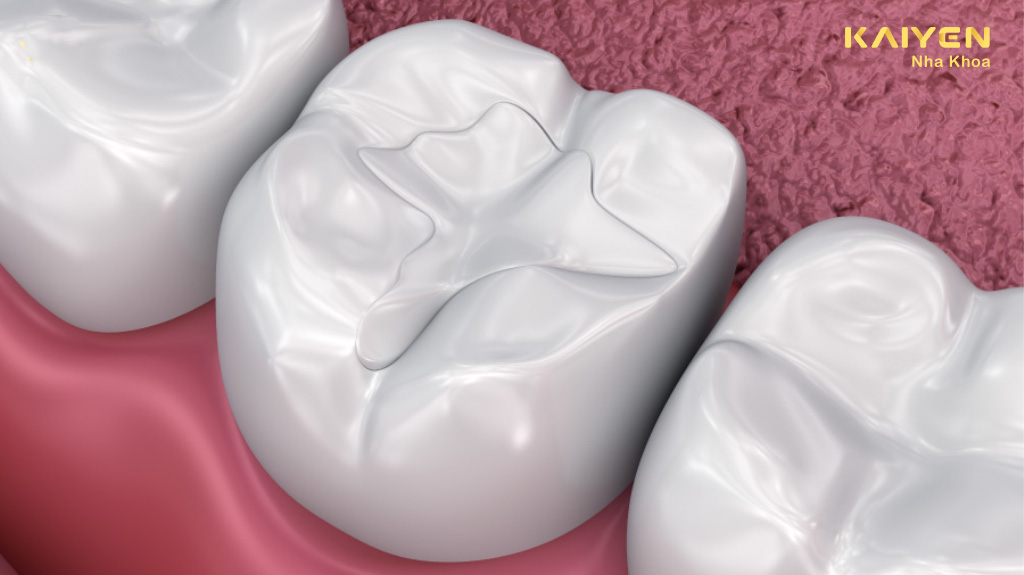 Trám răng sâu có bền không