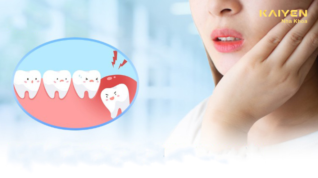 Mọc răng khôn bị sưng má