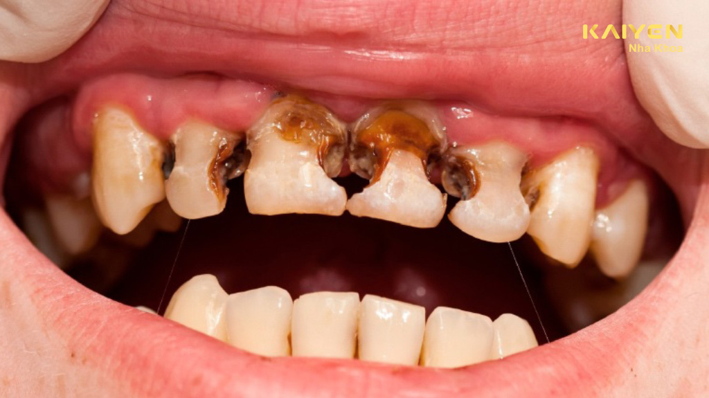 Răng sâu có lây không