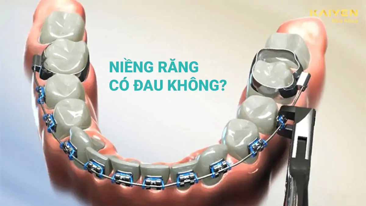 Niềng răng có đau không?