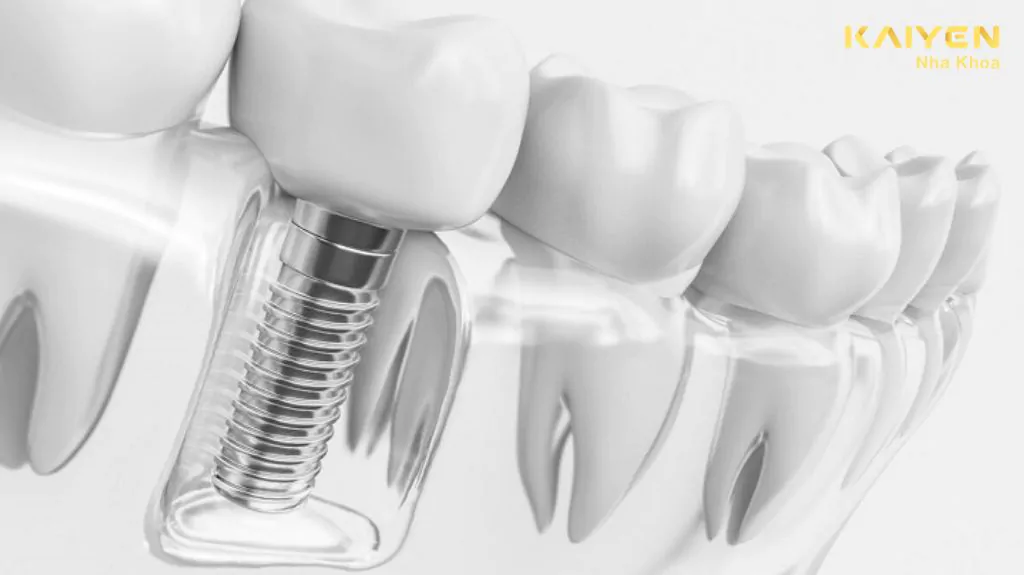 hút thuốc lá có trồng răng implant được không