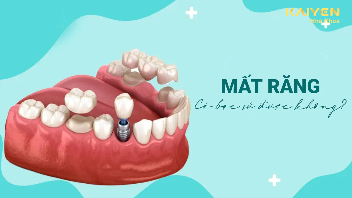 Mất răng có bọc sứ được không