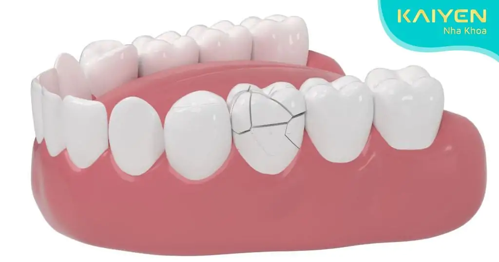 Biến chứng bọc răng sứ